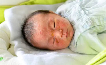 助産師に相談】赤ちゃんの顔や耳に湿疹のようなものが出ています。
