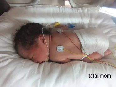 三つ子出産期】③緊急帝王切開編 